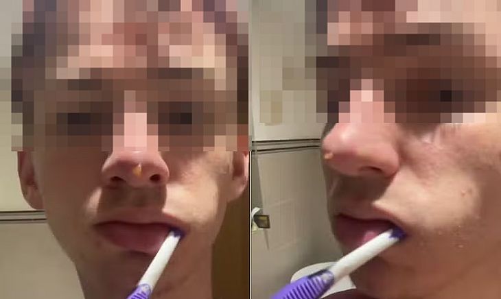 Um jovem da Inglaterra mostrou nas redes sociais o momento em que um fluido começa a vazar de seu nariz após realizar um procedimento de ''rinoplastia líquida''