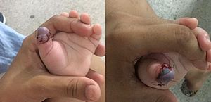Bebê aguarda atendimento há três dias e corre risco de ter dedo amputado, no HGE
