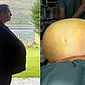 Médico descobre que 'obeso' tratado com Ozempic tinha na verdade um tumor de 27kg