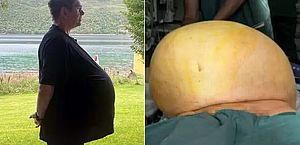 Médico descobre que 'obeso' tratado com Ozempic tinha na verdade um tumor de 27kg