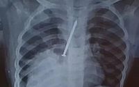 Menino de 3 anos morre após ficar um ano com prego no pulmão