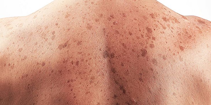 O câncer de pele está entre os mais frequentes na população. Quando diagnosticado de maneira rápida, as chances de cura são altas